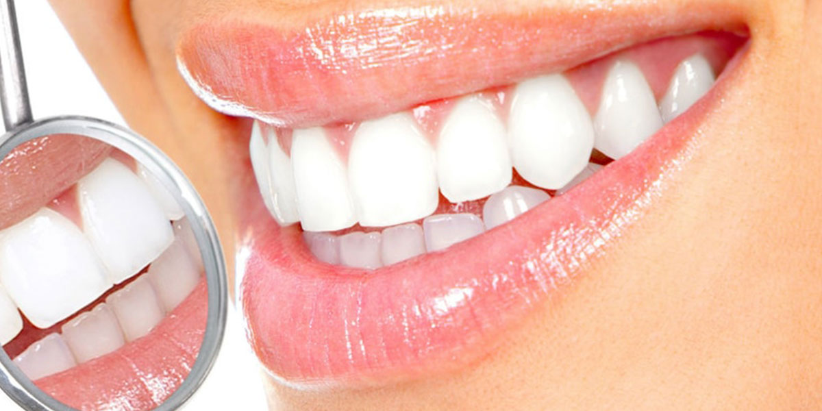سفید کردن دندانها